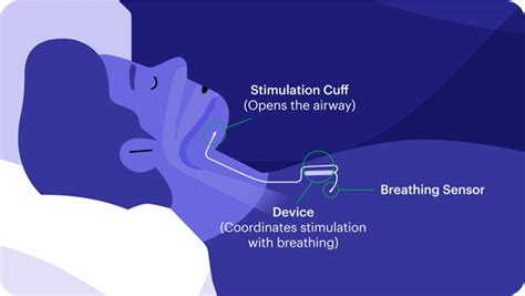 sleep apnea review of systems